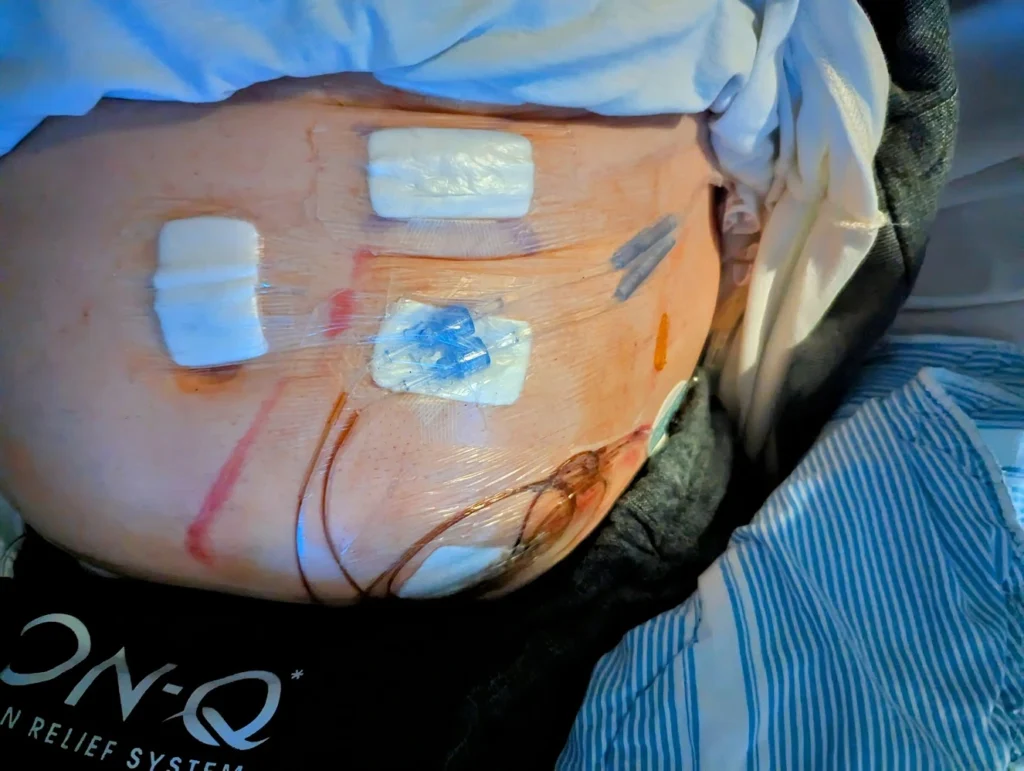 A bloated stomach and drug bag (relief system) containing morphine and laxatives.